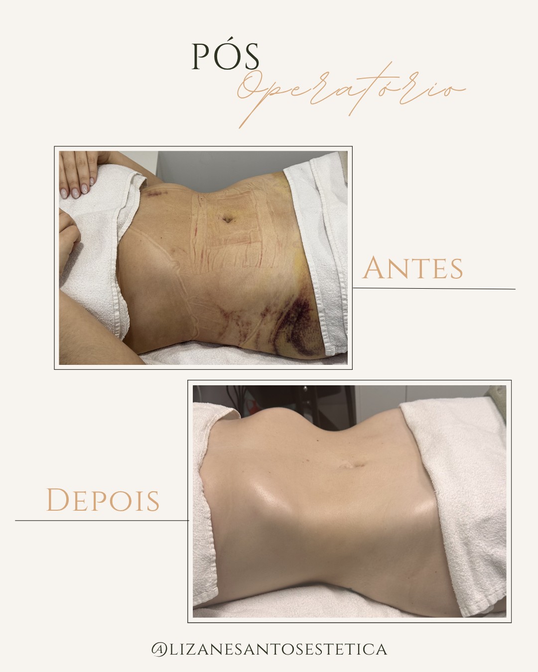 lipo sandra